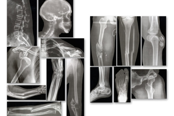 broken bones 2